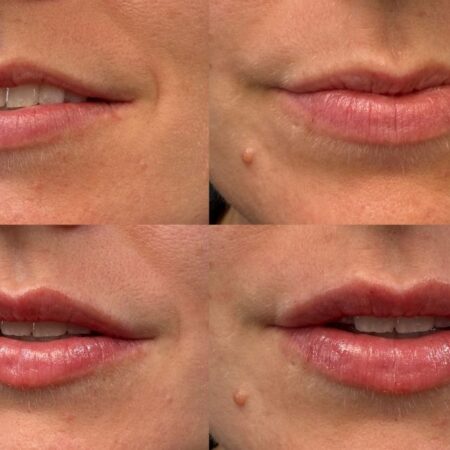 0.5ml vs 1ml Lip Filler