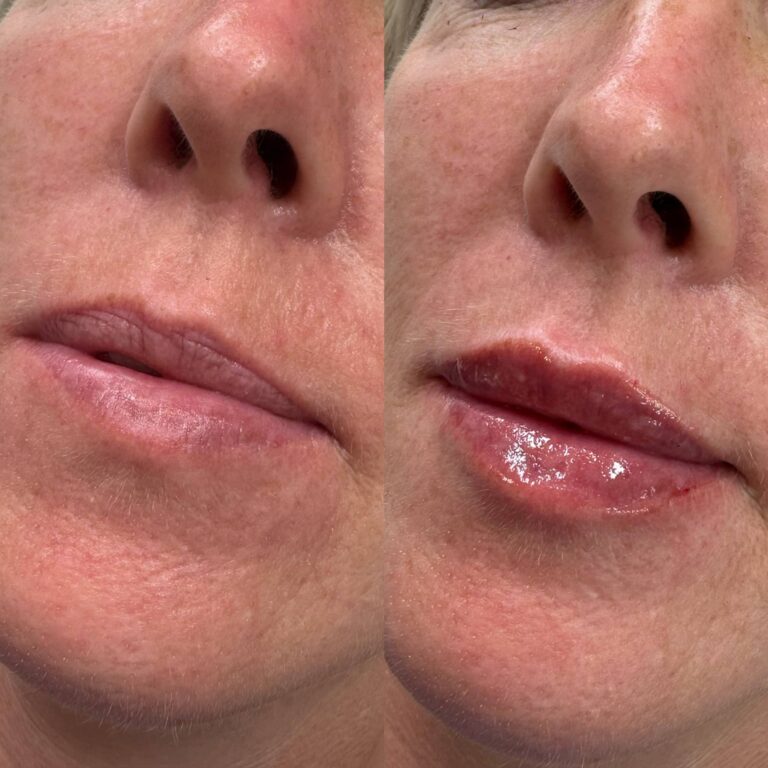 A stunning before and after image showing the the process of having lip fillers by Caroline from BU Aesthetics