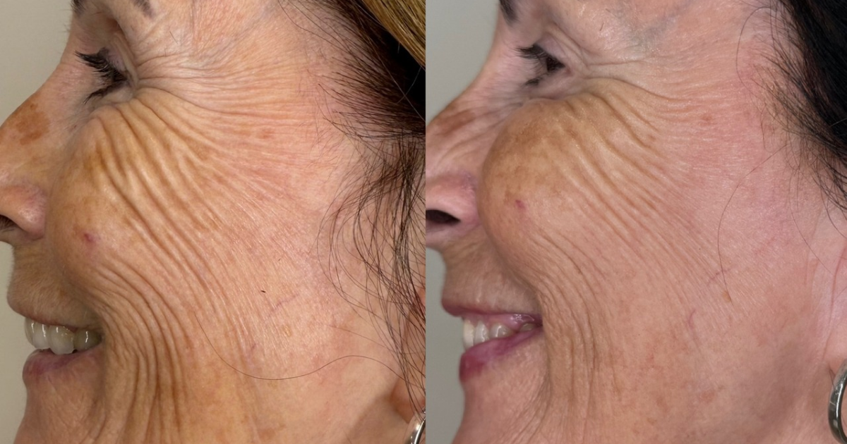 Someone after Morpheus8 Burst treatment.