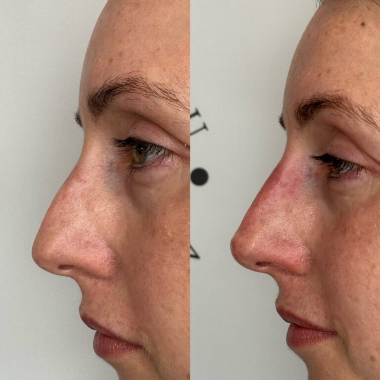Non-surgical rhinoplasty before and after