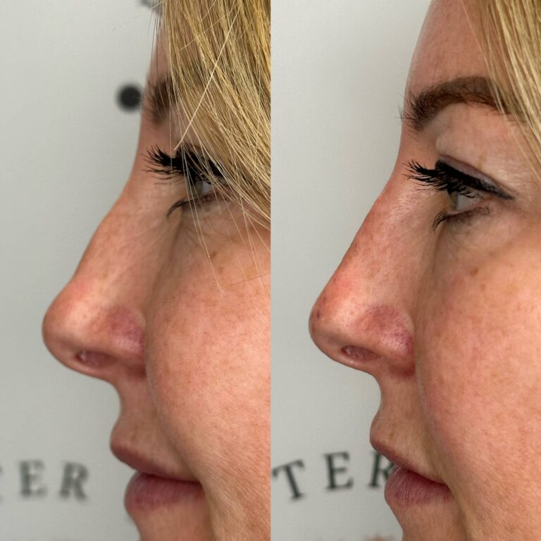 Non-surgical rhinoplasty before and after