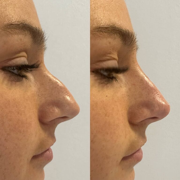 Non-surgical rhinoplasty before and after