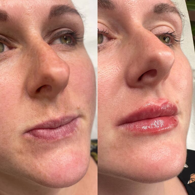 A stunning before and after image showing the benefits of the lip filler treatment with BU Aesthetics.