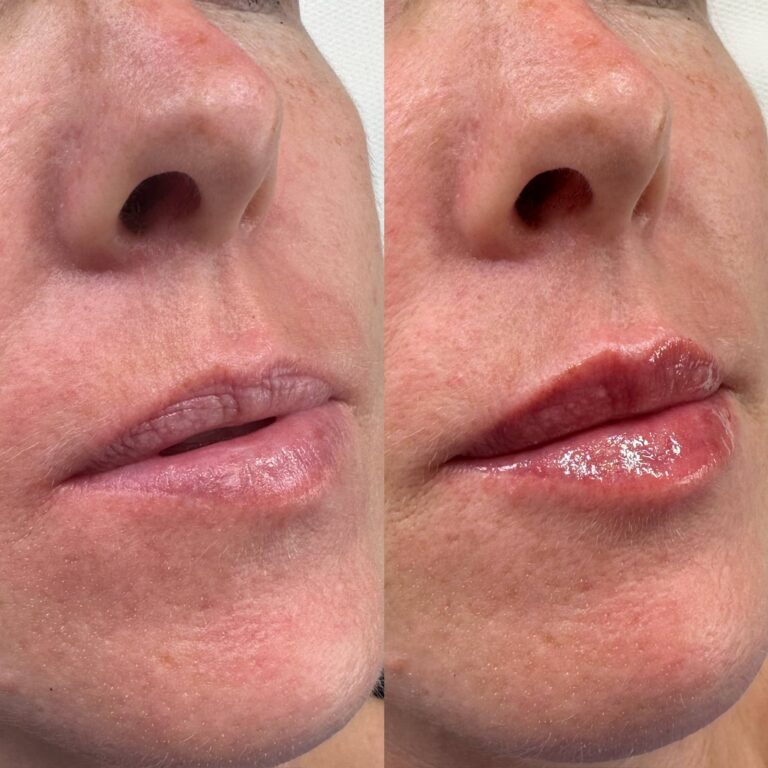 A stunning transformation image showing the before and after of undergoing a lip filler treatment with BU Aesthetics.