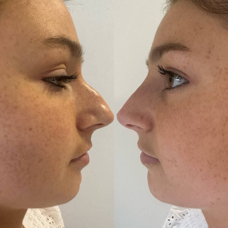 Non-surgical rhinoplasty before and after