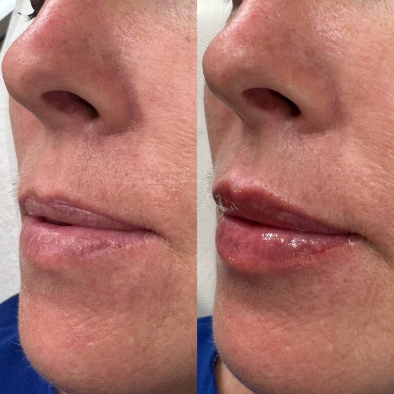 A stunning before and after image showcasing the benefits of Lip Filler Treatments with BU Aesthetics