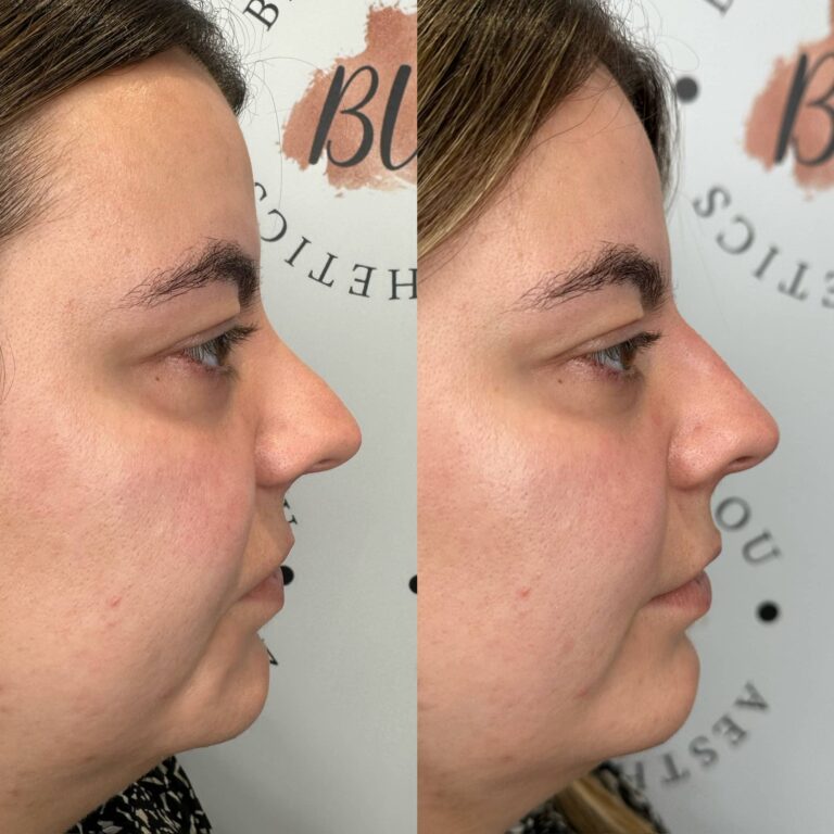 Non-surgical rhinoplasty before and after