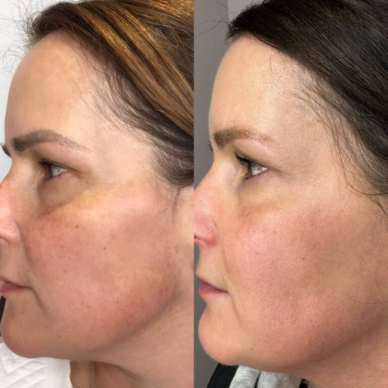 This before and after comparison shows a woman's face after using the Obagi Medical Grade Skincare treatment