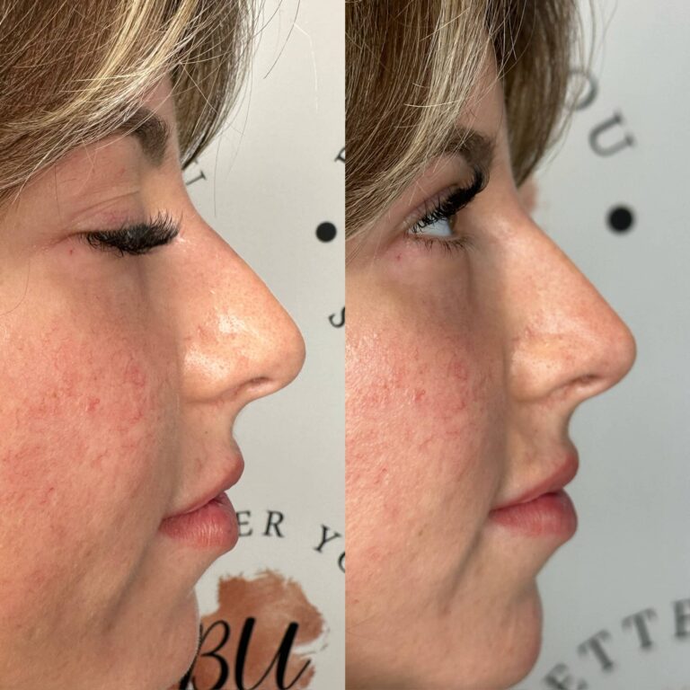 Non-surgical rhinoplasty before and after
