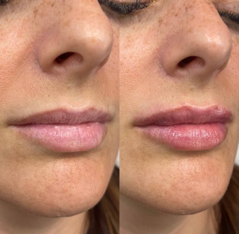 A before and after image showcasing the transformation of lip fillers