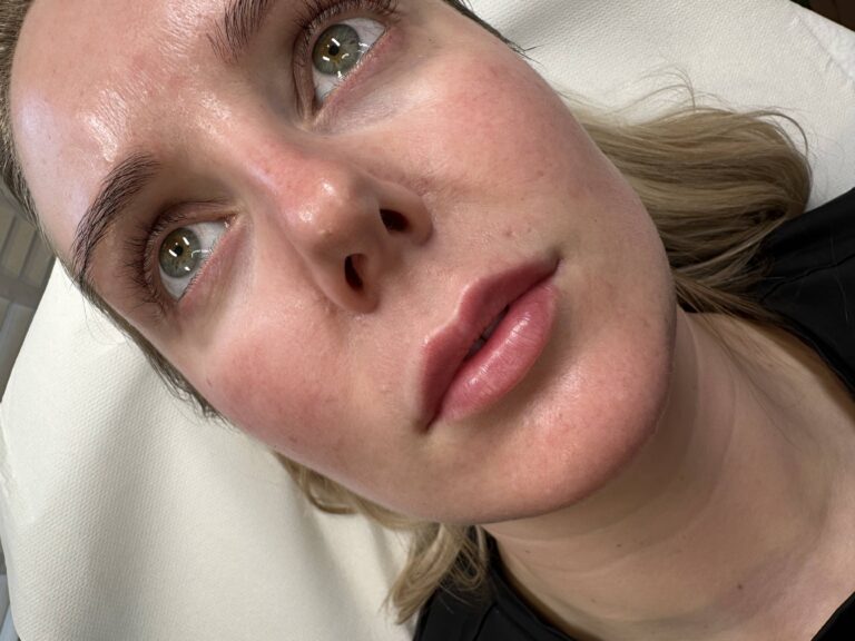 A stunning transformation that showcases the benefits of lip fillers