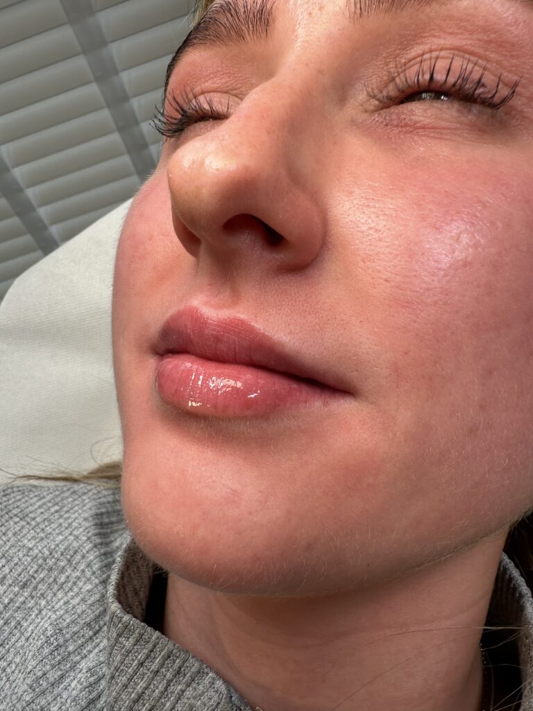 A stunning after image showcasing the amazing transformation of lip fillers