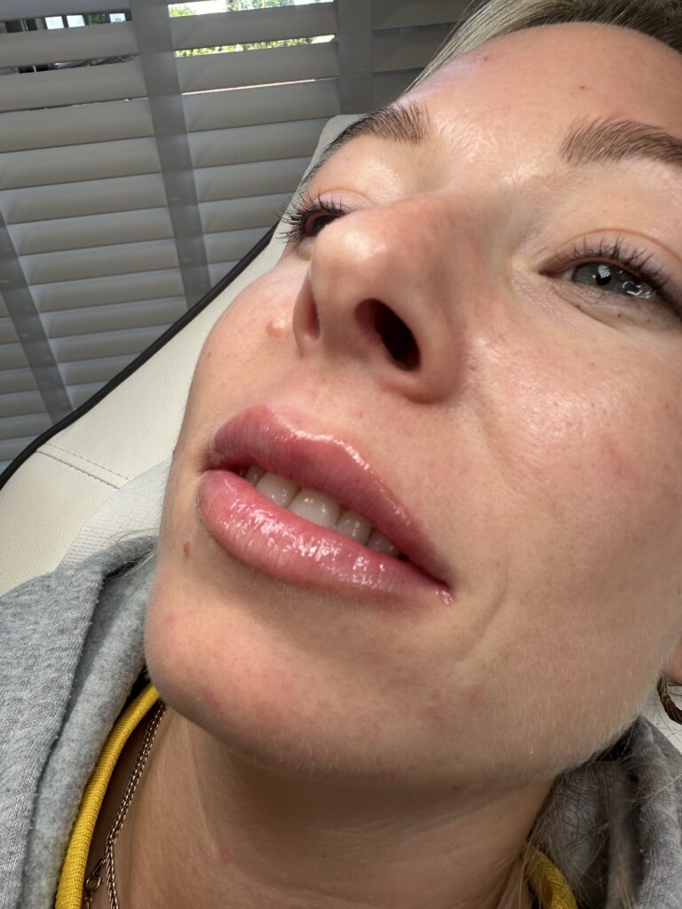 A before and after image of a woman receiving lip filler treatments with BU Aesthetics