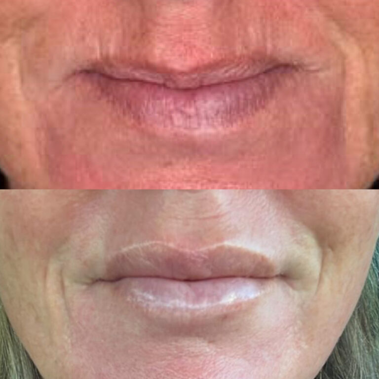A before and after image of a person receiving lip filler treatments
