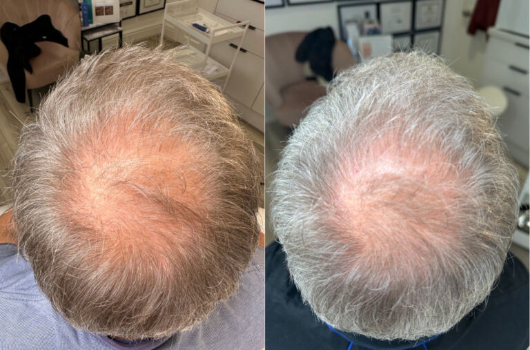 A top down image showing the before and after benefits of undergoing PRP For Skin And Hair that shows improved health of hair and it growing back