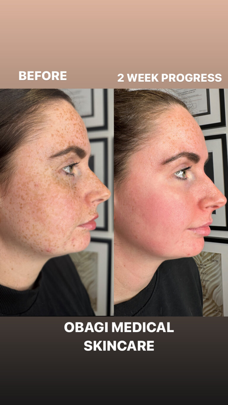 A social media image showcasing the amazing before and after benefits of the amazing Obagi Medical Grade Skincare treatment