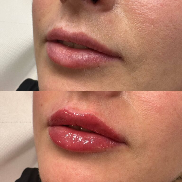 A stunning before and after image showcasing the benefits of receiving lip filler treatments