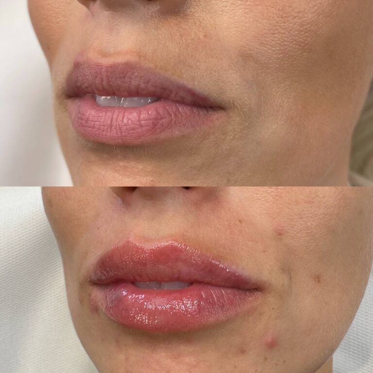 A stunning before and after image showcasing the benefits and aftermath of receiving lip fillers