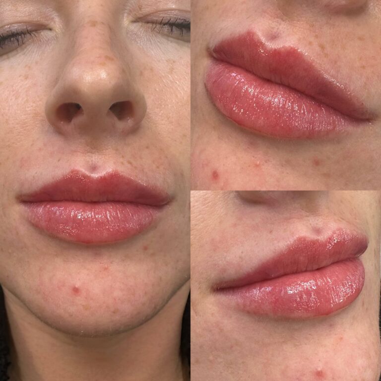 A stunning lip filler treatment provided by Carloline by BU Aesthetics