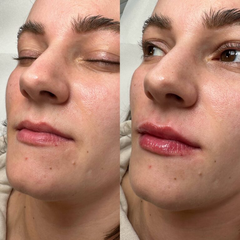A stunning before and after image showcasing the benefits of undergoing a lip filler treatment with BU Aesthetics