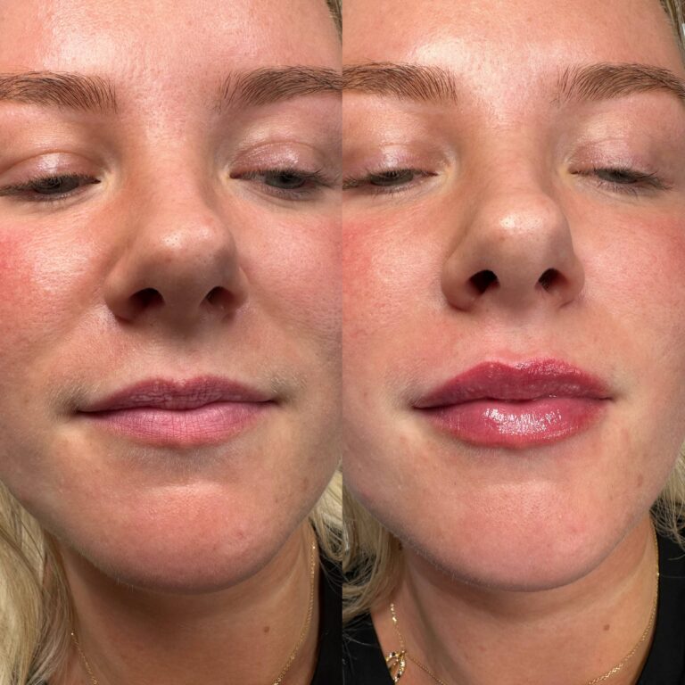 An amazing transformational photo showcasing the before and after of receiving lip filler treatments with BU Aesthetics and Caroline