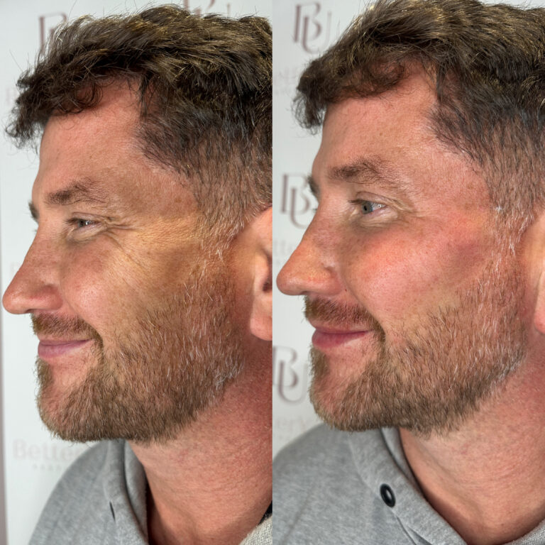 A before and after image of having the HArmonyCa treatment be conducted on a man