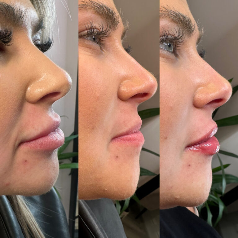 A stunning transformational image, showcasing the benefits of Lip Fillers that are offered with BU Aesthetics