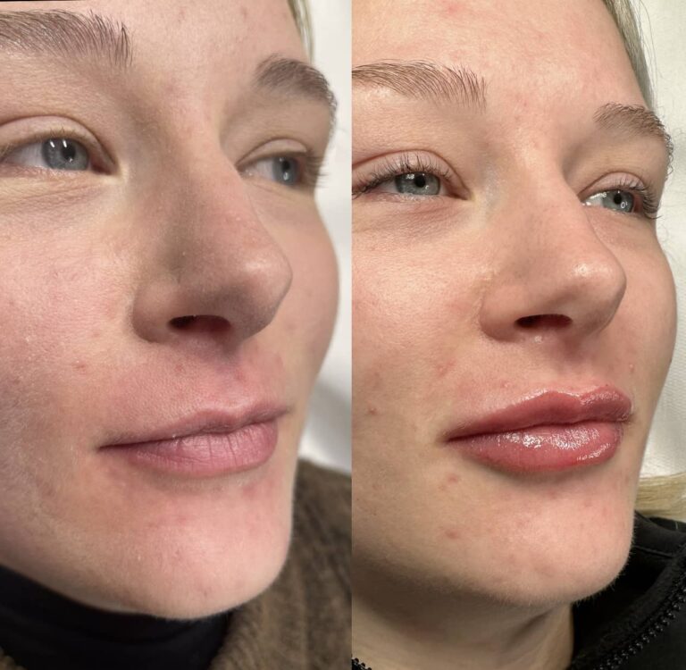 A stunning before and after image showcasing the benefits of BU Aesthetics with Caroline