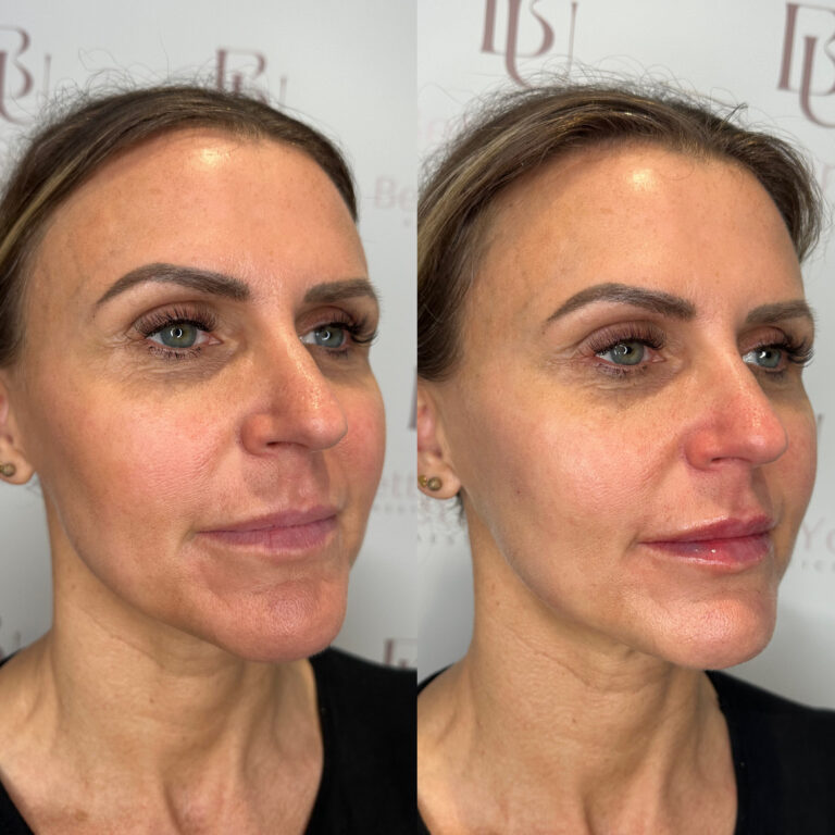 A stunning transformation of a woman's facial features through the HArmonyCa treatment with BU Aesthetics