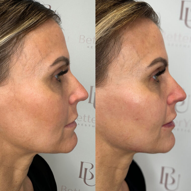 A before and after image of a patient undergoing the HArmonyCa treatment that is available through BU Aesthetics