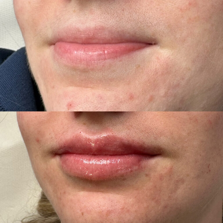 A stunning before and after image showcasing the benefits of lip fillers with Caroline and BU Aesthetics.