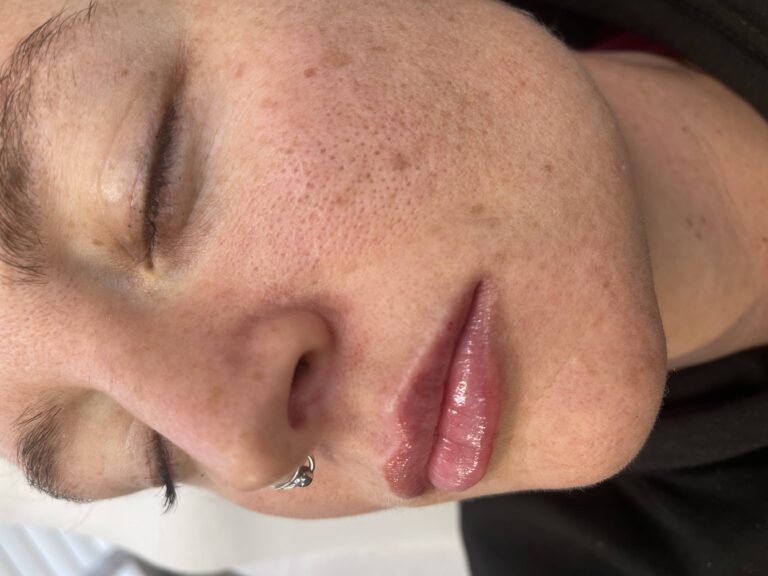 A stunning after image showing the benefits of lip fillers with BU Aesthetics
