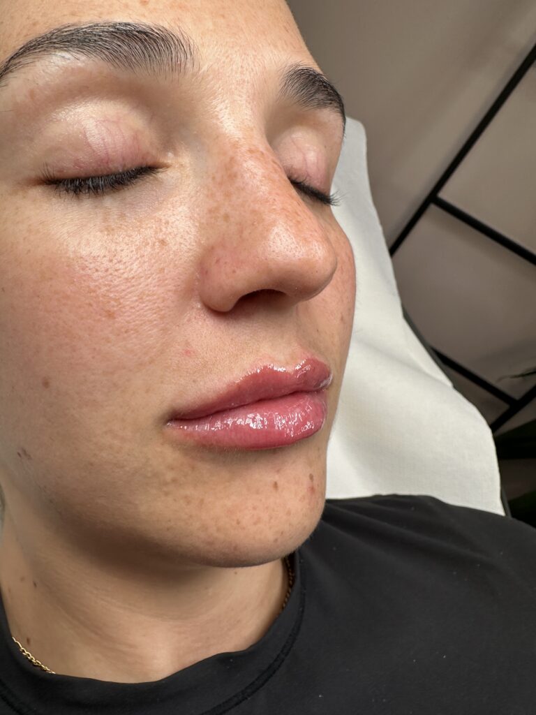 A stunning lip filler procedure photo, showcasing the benefits of receiving the treatment through Caroline and BU Aesthetics
