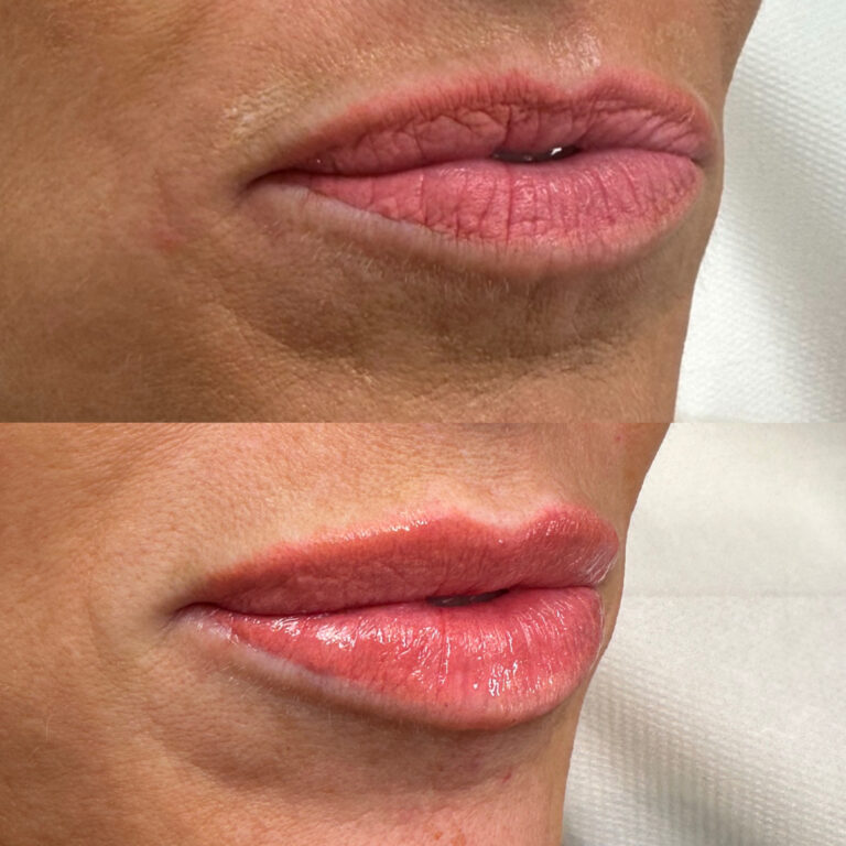 A before and after image showcasing how Lip Fillers can transform your facial features