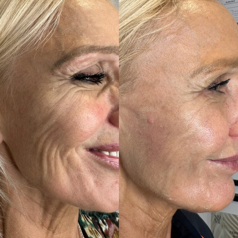 A stunning before and after comparison of the HArmonyCa treatment that is available with Caroline from BU Aesthetics
