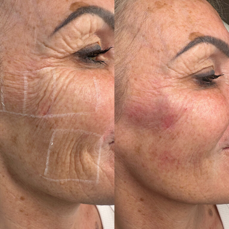A before and after image of a woman after undergoing the HArmonyCa procedure with BU Aesthetics