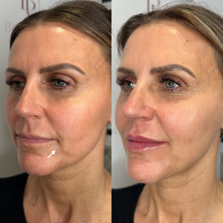 A before and after image of the HArmonyCa process through Caroline of BU Aesthetics.