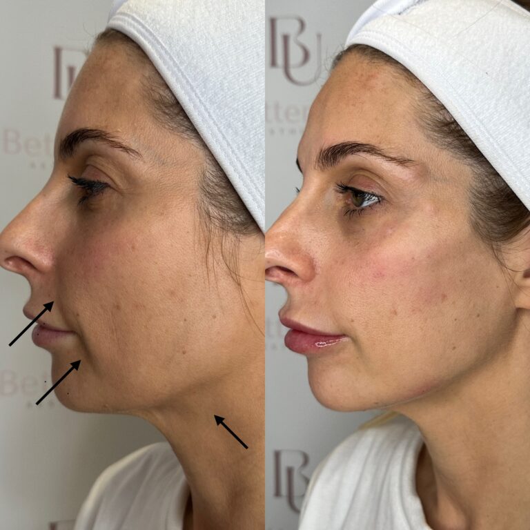 A before and after image of a patient undergoing a HArmonyCa process with Caroline with BU Aesthetics