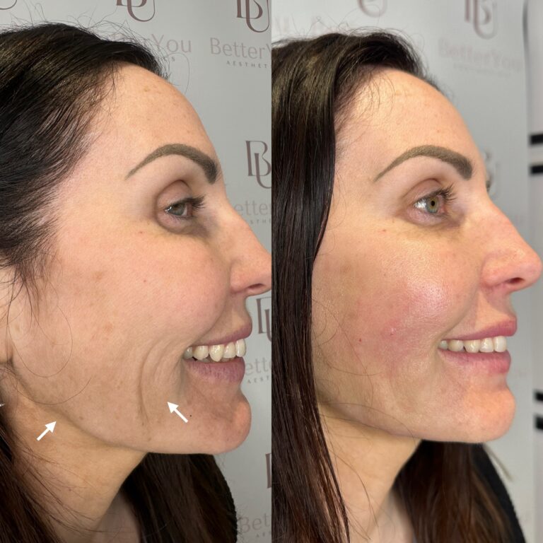 A before and after image of a patient undergoing a HArmonyCa treatment with BU Aethetics with Caroline