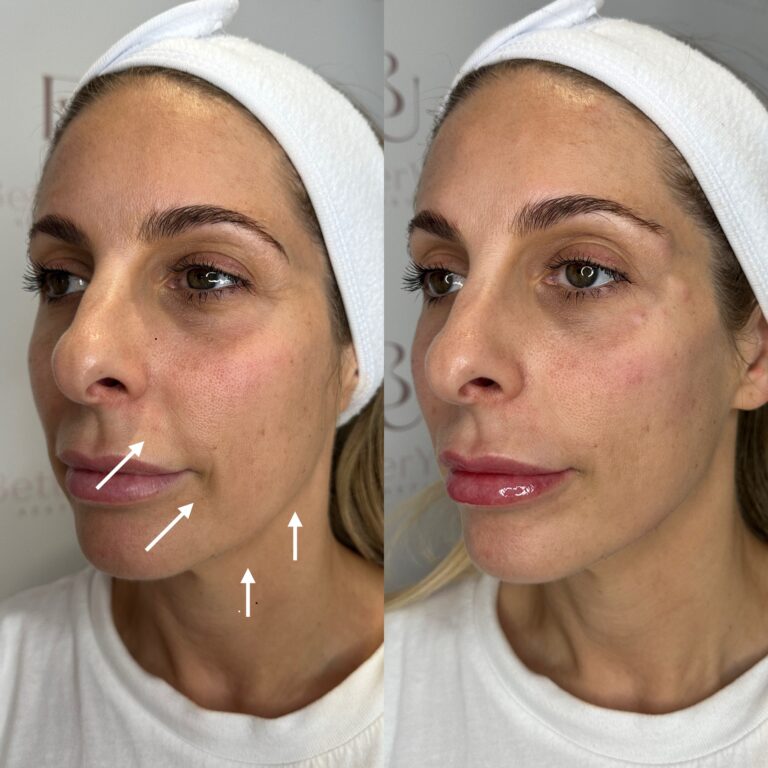 A before and after image, showing the process of undergoing the HArmonyCa treatment