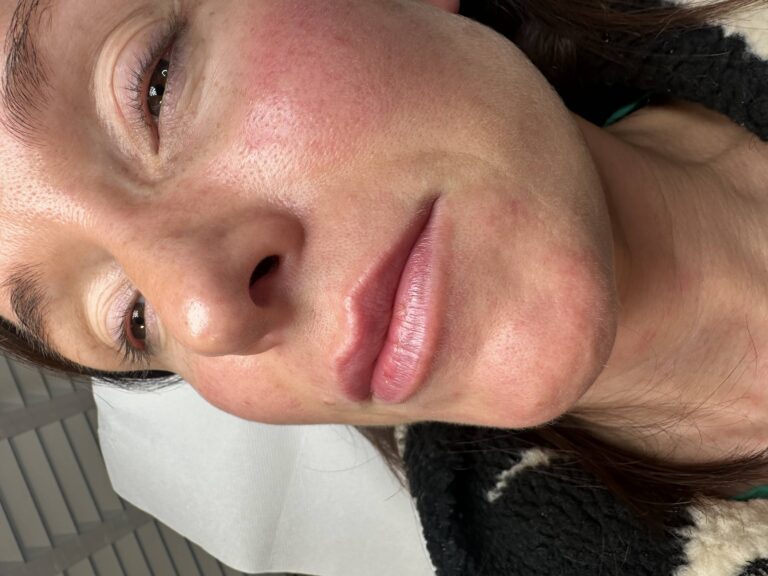 A stunning after image showcasing the amazing lip filler possibilities