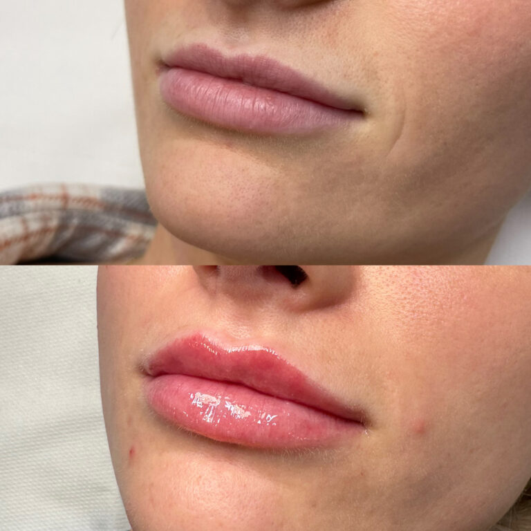 A stunning before and after photo showcasing how Lip Fillers can change your appearance