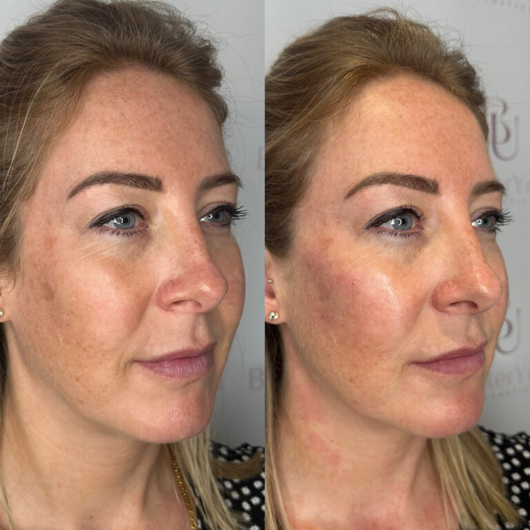 A before and after image showcasing the benefits of undergoing the HArmonyCa process