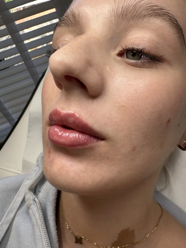 An amazing transformational photo, showcasing the benefits of undergoing a lip filler treatment with BU Aesthetics.