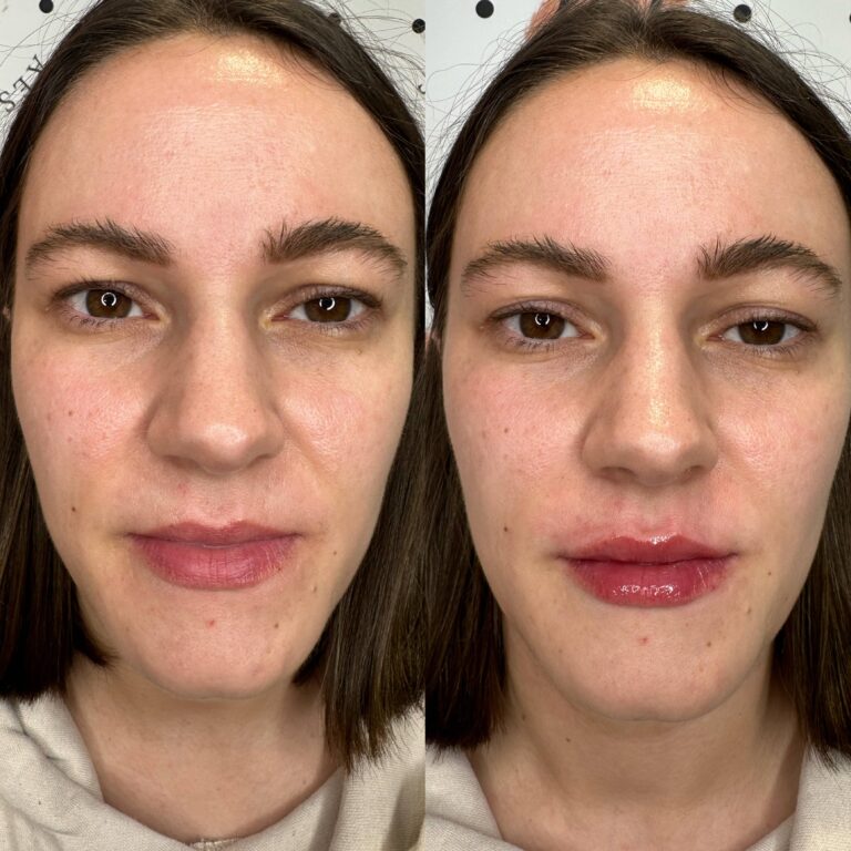 A stunning transformational photo showcasing the stark contrast of recieving lip filler treatments with BU Aesthetics