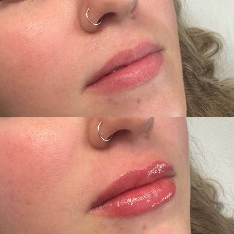 A stunning before and after image showing the transition of before receiving a lip filler treatment and after it.