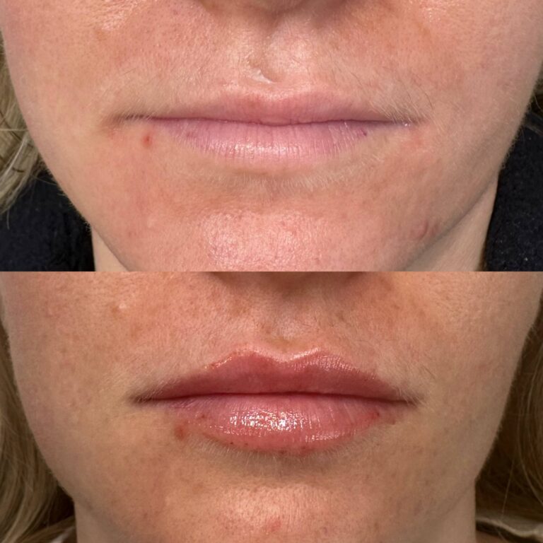 A striking before and after image of the process of receiving a successful lip filler treatment