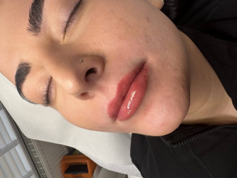 A stunning after image showcasing the transformation of undergoing a lip filler treatment for BU Aesthetics with Caroline
