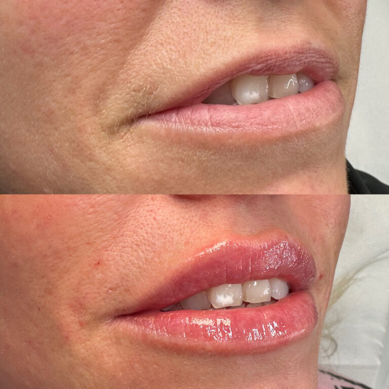 A transformational image showing the benefits of undergoing a lip filler treatment