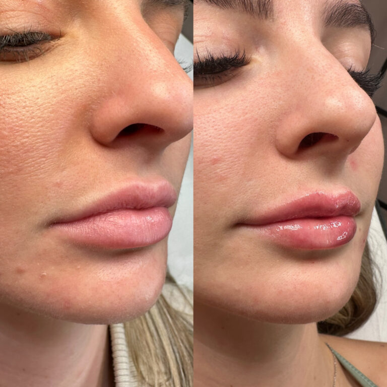 A before and after image, showing the stunning transformation of lip fillers